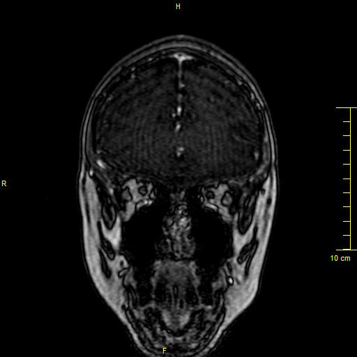 Cerebral venous thrombosis (Radiopaedia 23288-23351 MRV 16).JPG