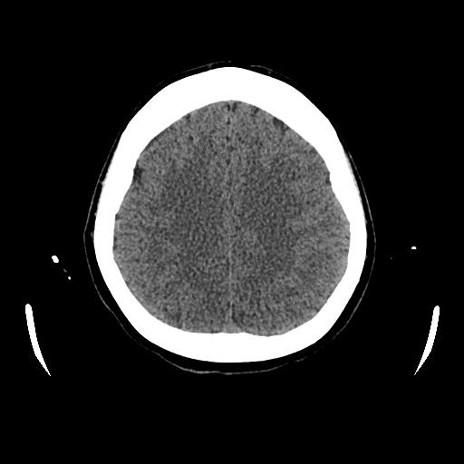 Cerebral venous thrombosis with venous hemorrhagic infarct (Radiopaedia 90354-107660 Axial non-contrast 37).jpg