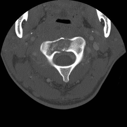 Cervical Pott disease (Radiopaedia 20374-20286 Axial bone window 35).jpg