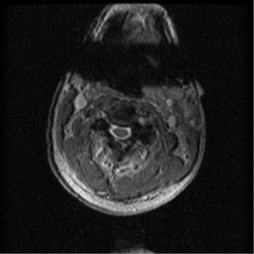 File:Cervical canal stenosis with cord compression (Radiopaedia 34114-35374 Axial Gradient Echo 72).png