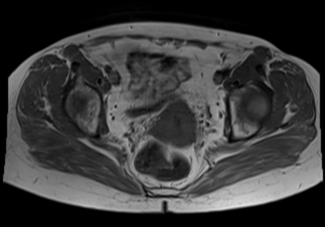 File:Cervical carcinoma (Radiopaedia 88312-104943 Axial T1 13).jpg