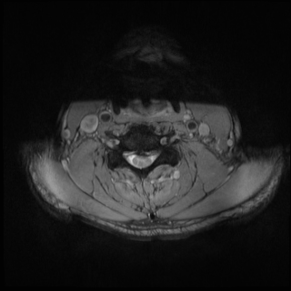 File:Cervical disc extrusion (Radiopaedia 53950-60077 Axial T2 18).jpg