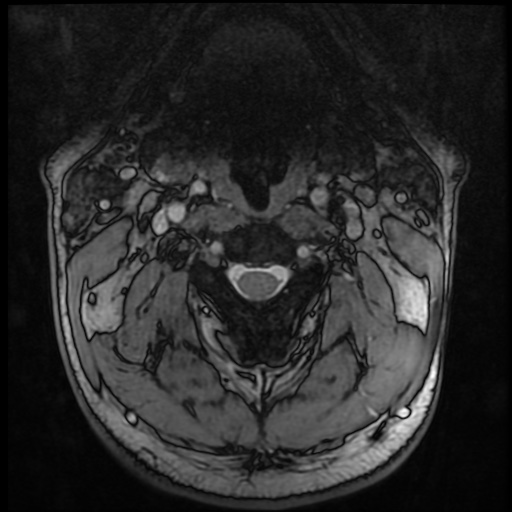 Cervical disc extrusion (Radiopaedia 59074-66364 G 11).jpg