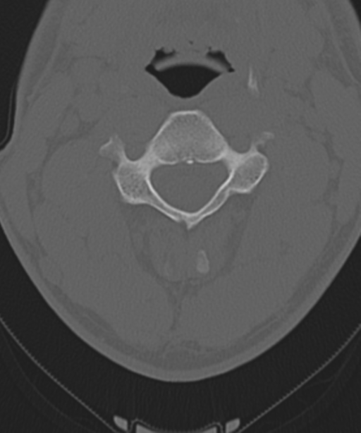 Cervical intercalary bone (Radiopaedia 35211-36748 Axial bone window 26).png