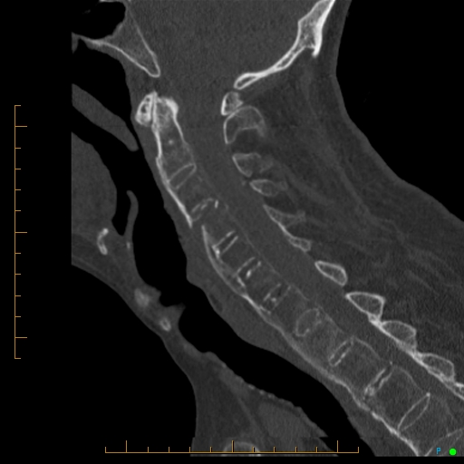 Cervical spine fracture - ankylosing spondylitis (Radiopaedia 76835-88706 Sagittal bone window 60).jpg