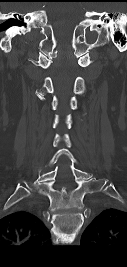Cervical spine fracture - chalk stick (Radiopaedia 39116-41323 Coronal bone window 28).png