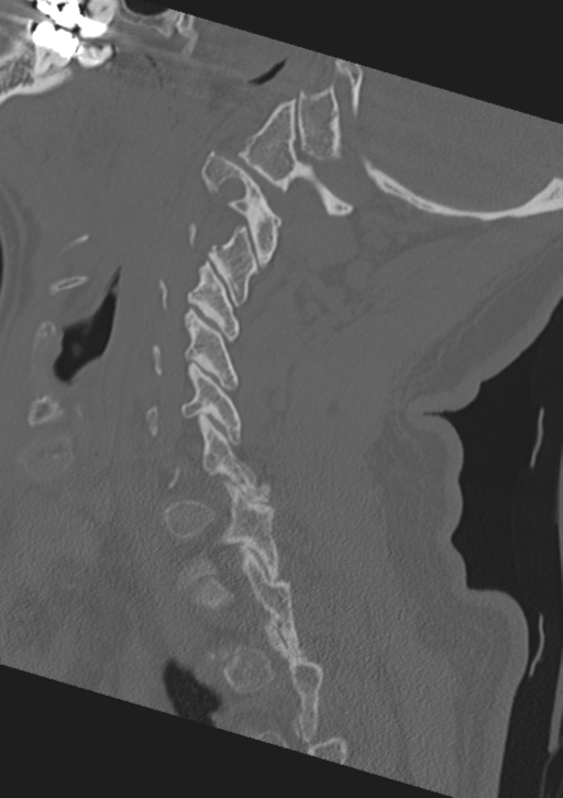 Cervical spine fractures with vertebral artery dissection (Radiopaedia 53296-59268 Sagittal bone window 22).png
