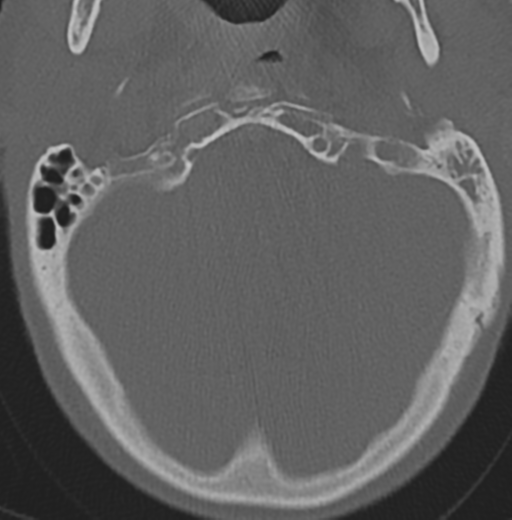 File:Cervical spondylolysis (Radiopaedia 49616-54811 Axial bone window 7).png