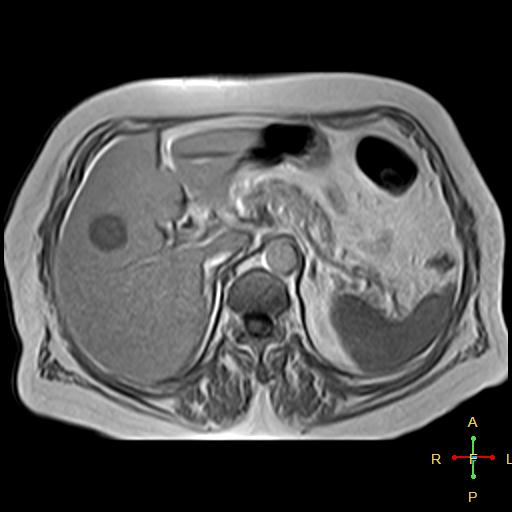 File:Cervical stump squamous cell carcinoma (Radiopaedia 48049-52858 H 9).jpg