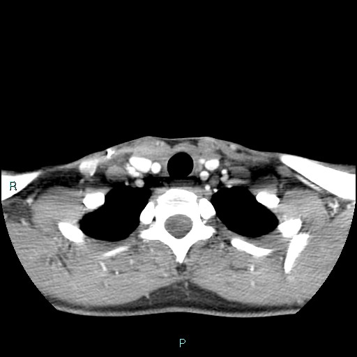 Cervical thymic cyst (Radiopaedia 88632-105335 B 32).jpg