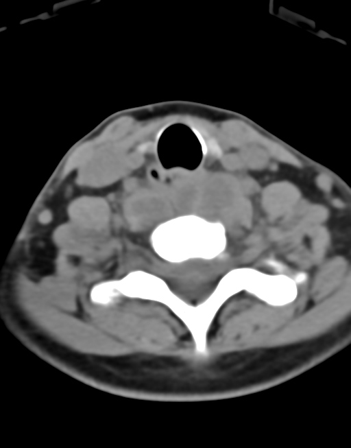Cervical tuberculous spondylitis (Radiopaedia 39149-41365 Axial non-contrast 41).png