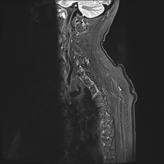 File:Cervical tumor-like myelopathy due to Type V dAVF (Radiopaedia 82461-96604 Sagittal STIR 2).jpg