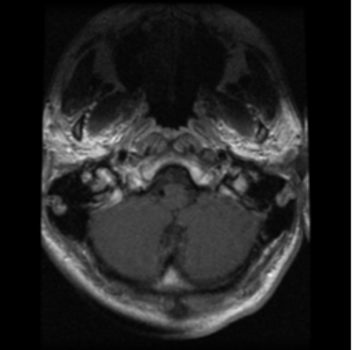 File:Cervical vertebrae metastasis (Radiopaedia 78814-91667 Axial T1 C+ 29).png