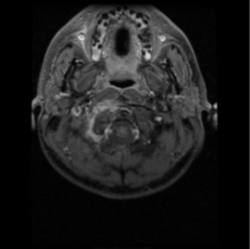 File:Cervical vertebrae metastasis (Radiopaedia 78814-91667 Axial T1 C+ fat sat 13).png