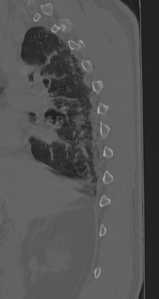 Chance fracture (Radiopaedia 33854-35020 Sagittal bone window 67).png