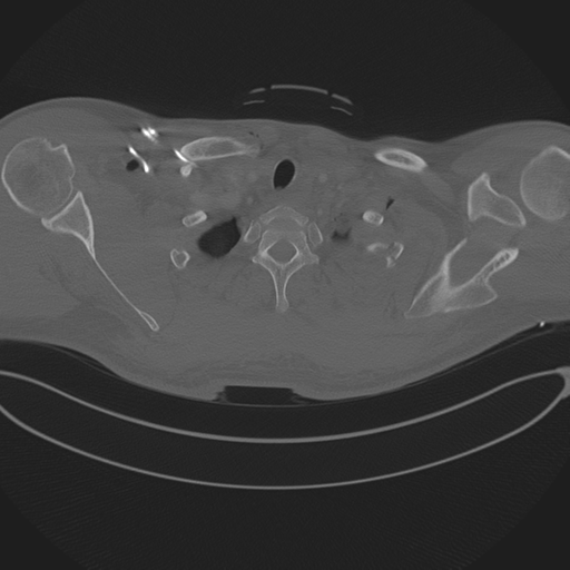 Chest multitrauma - aortic injury (Radiopaedia 34708-36147 Axial bone window 26).png