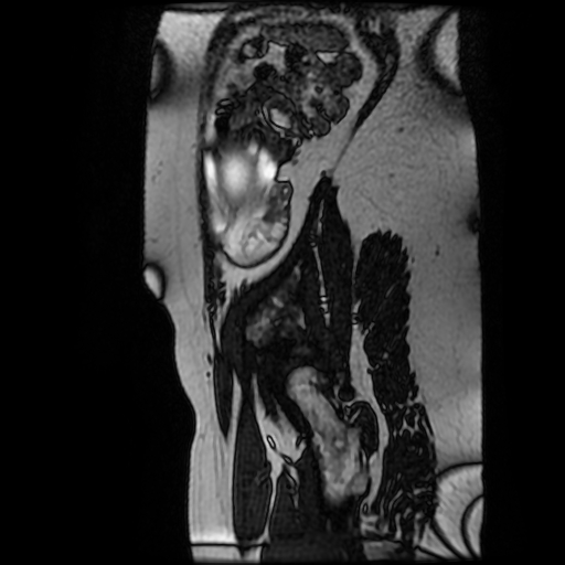 Chiari II malformation - fetal MRI (Radiopaedia 68099-77581 Sagittal Fiesta 4).jpg