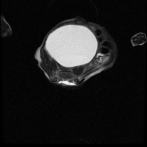 File:Chiari II malformation with spinal meningomyelocele (Radiopaedia 23550-23652 Axial T2 15).jpg