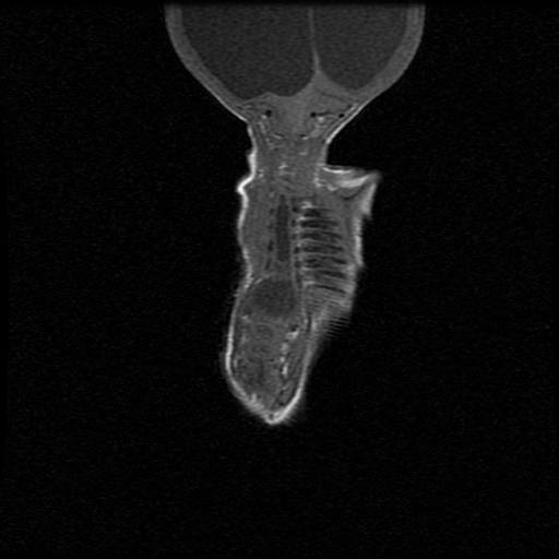File:Chiari II malformation with spinal meningomyelocele (Radiopaedia 23550-23652 Coronal T1 8).jpg
