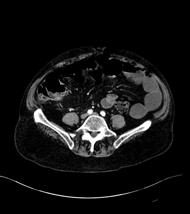 Cholangiocarcinoma with cerebral metastases (Radiopaedia 83519-98629 B 80).jpg
