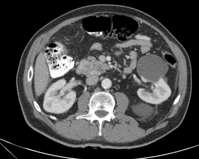 Cholecystitis - perforated gallbladder (Radiopaedia 57038-63916 A 39).jpg