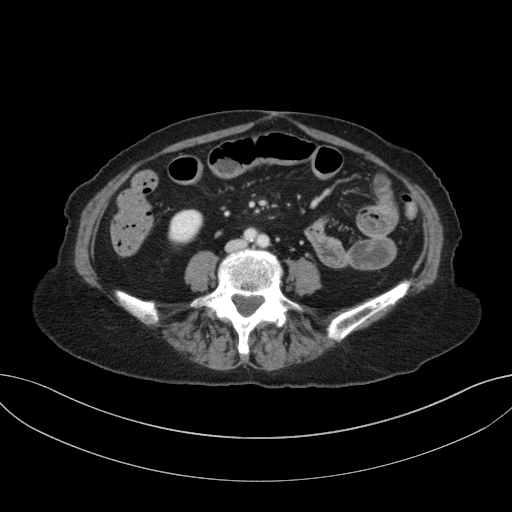 Cholecystoduodenal fistula due to calculous cholecystitis with gallstone migration (Radiopaedia 86875-103077 D 49).jpg