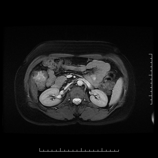 File:Choledochal cyst with chronic calcific pancreatitis (Radiopaedia 18245-18062 Axial T2 11).png