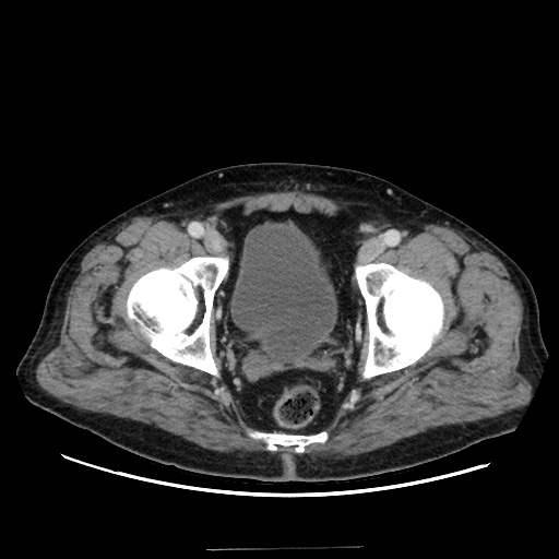 Choledocholiathiasis with normal caliber common bile duct (Radiopaedia 75368-86632 A 177).jpg