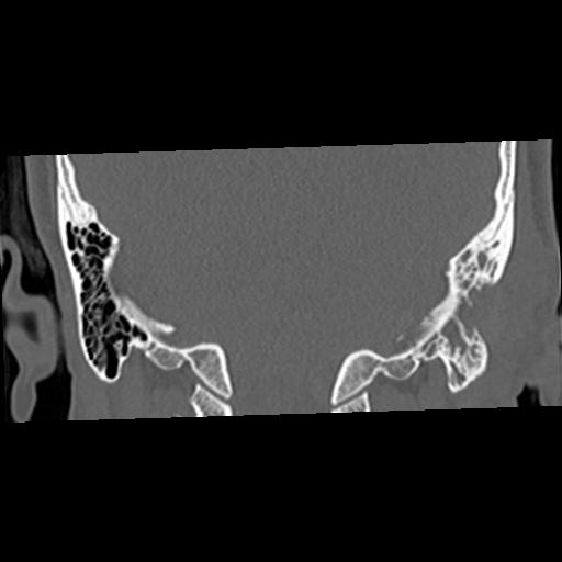 Cholesteatoma (Radiopaedia 84960-100474 Coronal bone window 49).jpg