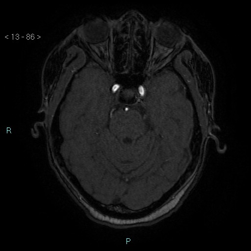 Cholesterol granuloma of the petrous apex (Radiopaedia 64358-73140 Axial TOF 3D 41).jpg