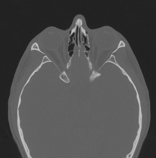 Chondrosarcoma (clivus) (Radiopaedia 46895-51425 Axial bone window 25).png