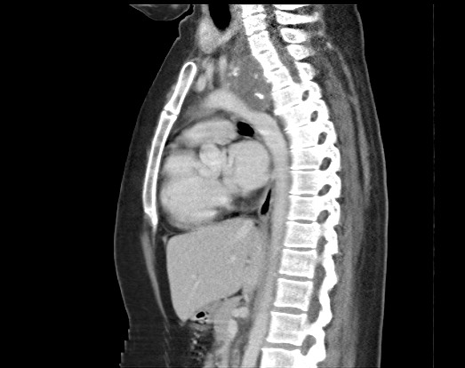 Chondrosarcoma - chest wall (Radiopaedia 65192-74199 B 30).jpg