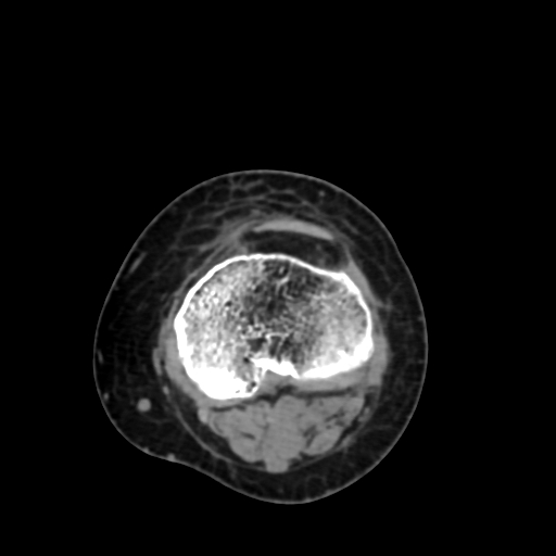 File:Chondrosarcoma - femur (Radiopaedia 64187-72954 Axial non-contrast 62).jpg