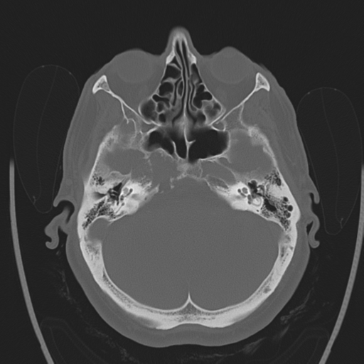 Chondrosarcoma of skull base- grade II (Radiopaedia 40948-43653 Axial bone window 10).png