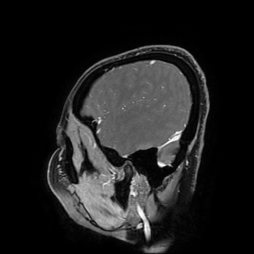 Chordoid glioma of third ventricle (Radiopaedia 91612-109340 F 170).jpg