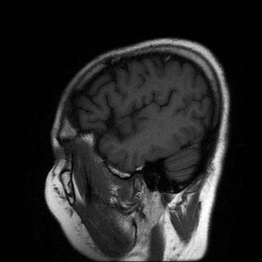 File:Chordoid glioma of third ventricle (Radiopaedia 91612-109340 Sagittal T1 23).jpg