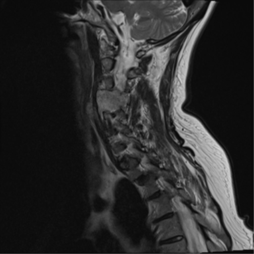 File:Chordoma (C4 vertebra) (Radiopaedia 47561-52189 Sagittal T2 10).png