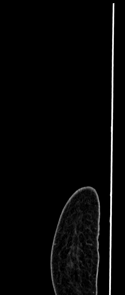 Choriocarcinoma liver metastases (Radiopaedia 74768-85766 C 16).jpg