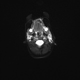 File:Choroid plexus papilloma (Radiopaedia 84612-100019 Axial DWI 2).jpg