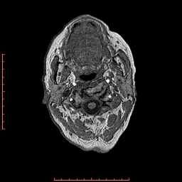 Choroid plexus xanthogranuloma (Radiopaedia 67843-77270 Axial T1 163).jpg