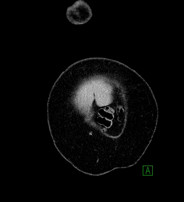 Chromophobe renal cell carcinoma (Radiopaedia 84239-99519 F 3).jpg