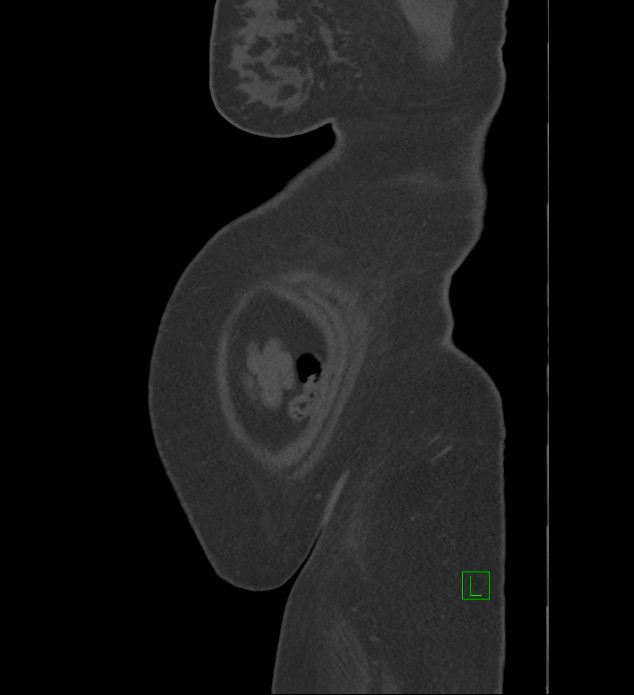 Chromophobe renal cell carcinoma (Radiopaedia 84239-99519 Sagittal bone window 1).jpg
