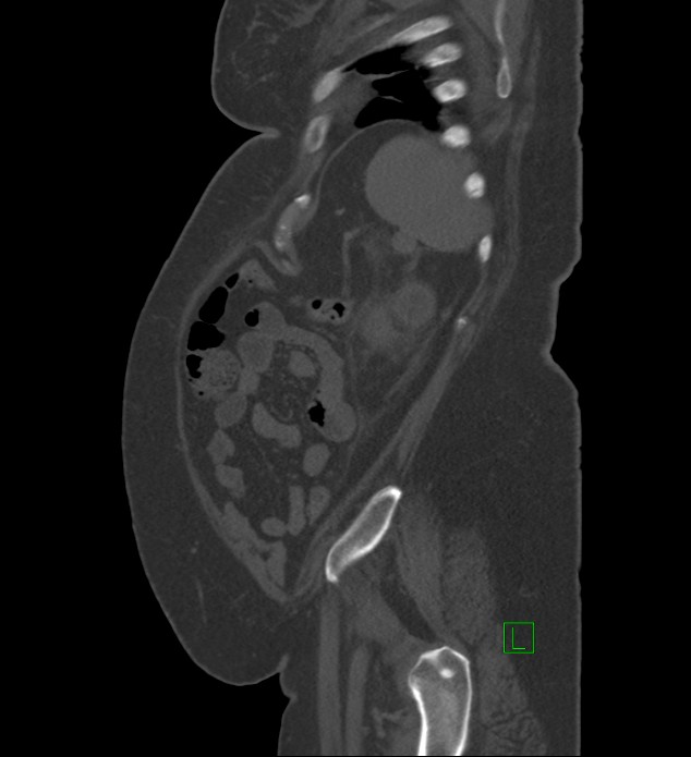 Chromophobe renal cell carcinoma (Radiopaedia 84239-99519 Sagittal bone window 16).jpg