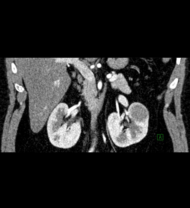 Chromophobe renal cell carcinoma (Radiopaedia 84286-99573 E 33).jpg