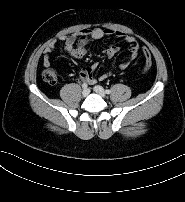 Chromophobe renal cell carcinoma (Radiopaedia 84286-99573 G 49).jpg