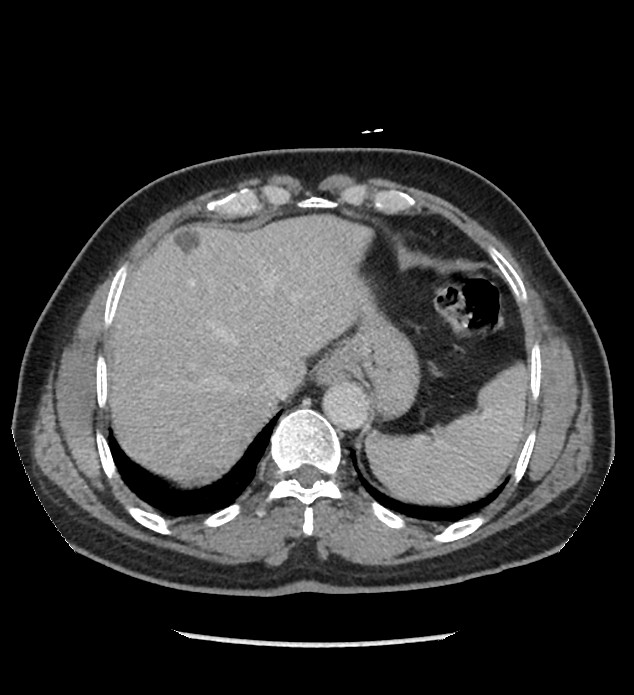 Chromophobe renal cell carcinoma (Radiopaedia 86879-103083 C 19).jpg