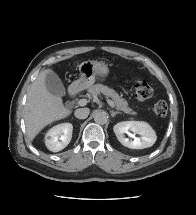 Chromophobe renal cell carcinoma (Radiopaedia 86879-103083 D 41).jpg