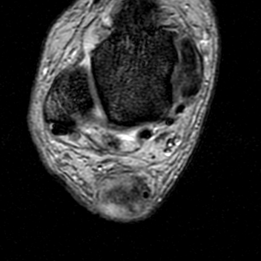 File:Chronic Achilles tendon rupture (Radiopaedia 15262-15100 Axial Gradient Echo 14).jpg