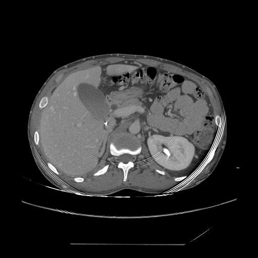 File:Chronic IVC thrombosis and resultant IVC filter malposition (Radiopaedia 81158-94800 A 59).jpg