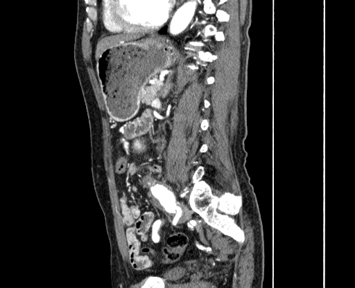 Chronic contained rupture of abdominal aortic aneurysm with extensive erosion of the vertebral bodies (Radiopaedia 55450-61901 B 47).jpg
